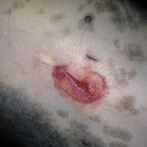 Hayden.  Incision is inflammed and infected.