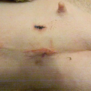 Diamond, 2 days after surgery